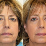 Blepharoplasty